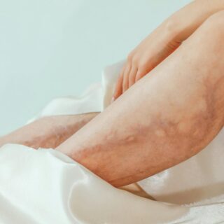 Varicose Vein Treatment