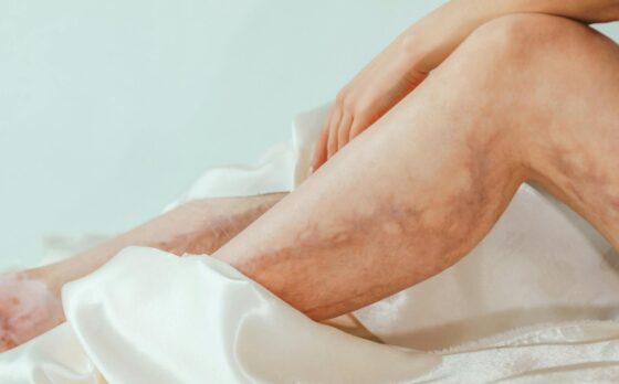 Varicose Vein Treatment