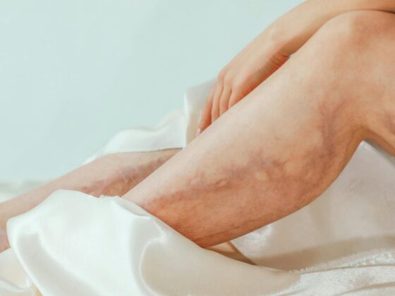 Varicose Vein Treatment